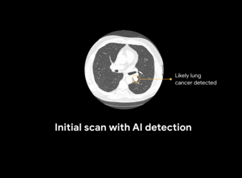 Google Develops AI-Model To Detect Lung Cancer Risks