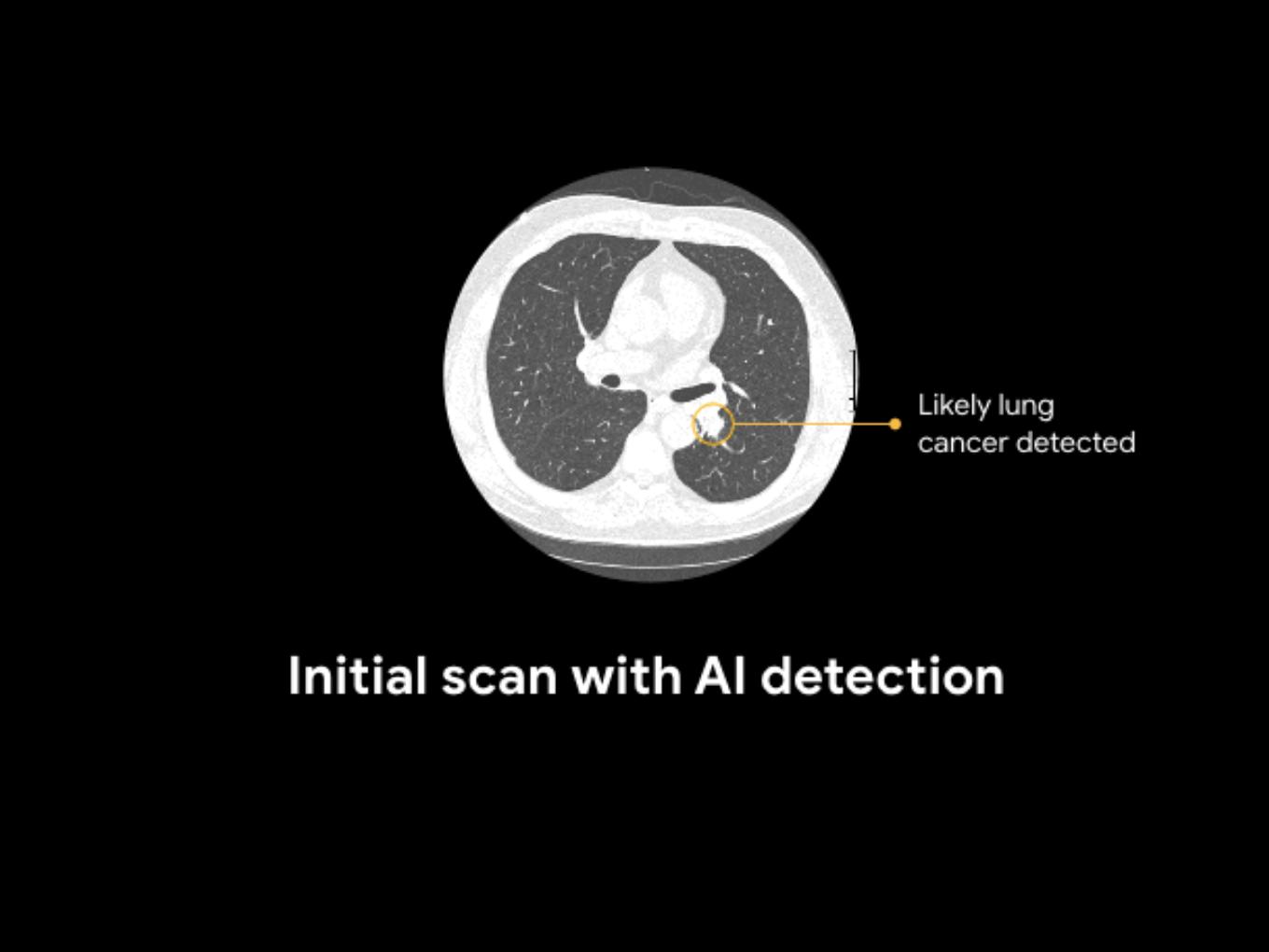 Google Develops AI-Model To Detect Lung Cancer Risks